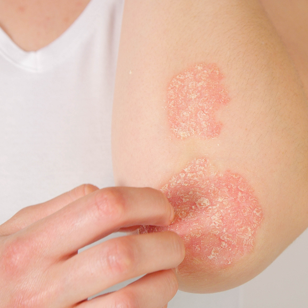 Psoriasis